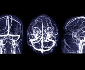 Contrast MR Venography