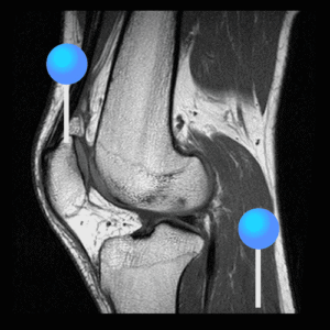 CT knee