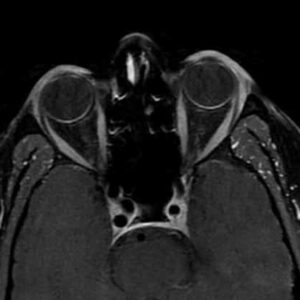 Contrast MRI PNS
