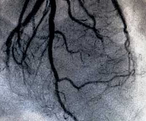 CT Cardiac Angiography